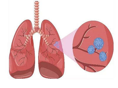 肺结节是什么？这种情况需要引起重视