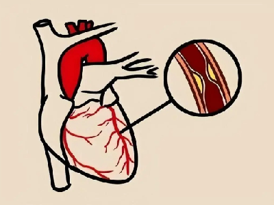 心血管疾病怎么检查？哪些人需要做心血管检查？
