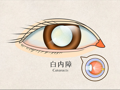 白内障是什么 早期该如何筛查