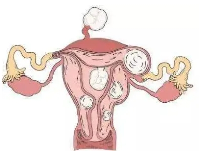 子宫肌瘤2.jpg