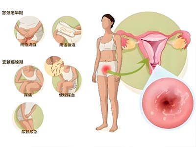 宫颈癌的临床表现是什么 它的筛查方式有哪些