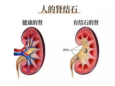 你对肾结石的了解有多少 肾结石是不容忽视的“隐形杀手”