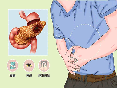 怀疑胰腺癌需要做什么检查 超过这个年龄段一定要筛查