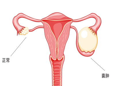 子宫囊肿的危害 可以这样预防子宫囊肿