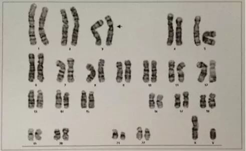 染色体检查报告单怎么看？什么是染色体