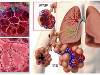 肺气肿的主要症状与表现