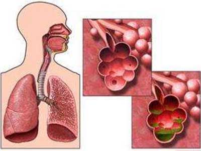 肺气肿的主要症状与表现
