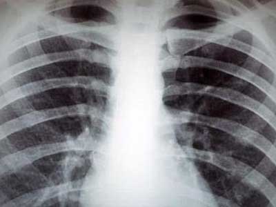 肺部X光能检查哪些疾病