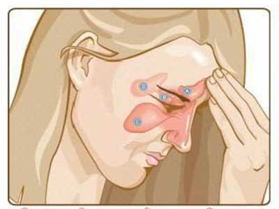 鼻窦炎有哪些症状？日常生活中如何预防保健？