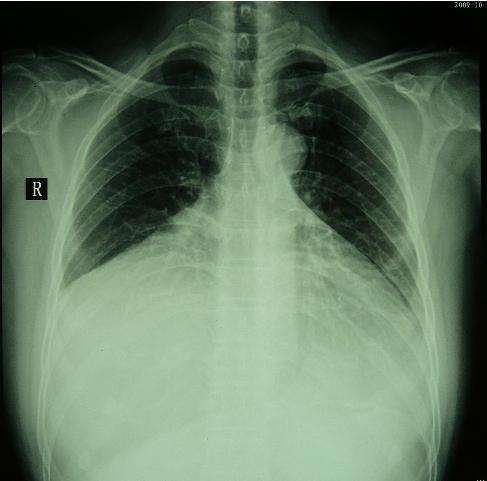 胸腔CT能检查出什么