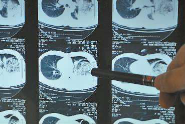 胸腔CT能检查出什么