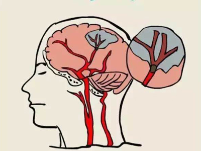 脑卒中的发病原因