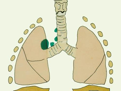 肺癌第1个高危信号很多人忽视了