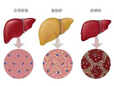 体检查出有脂肪肝，会不会变成肝癌？