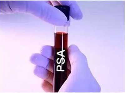 　　虽然PSA是最常用的检测前列腺癌的手段，但良性前列腺增生和前列腺炎也会出现PSA阳性的结果，解决该问题的一个方法就是检测游离前列腺特异性抗原。研究表明，在前列腺癌患者中，绝大部分PSA为结合状态，其游离PSA/总PSA的比值低于正常人或良性前列腺增生患者。因此，对总PSA异常升高的男性，检测游离PSA，通过计算游离PSA与总PSA比值可以提高筛查和诊断前列腺癌的特异性。