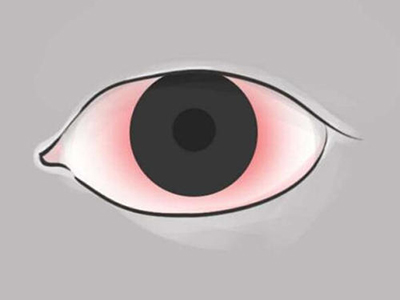 眼睛充血可以做哪些检查，筛查病因？