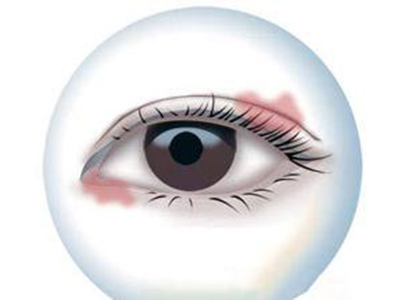 眼睛充血可以做哪些检查，筛查病因？