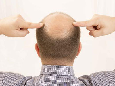 女性脱发六大因素，避开它保护好你的秀发！