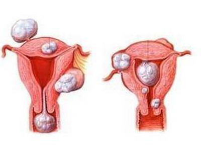 三类女性要当心子宫肌瘤 预防从这里入手