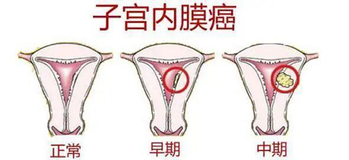 子宫内膜癌检查什么项目