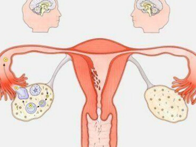 卵巢癌的4个典型症状