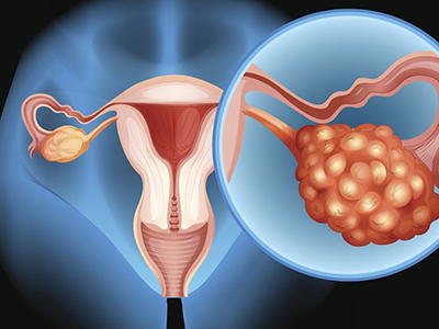 最易引发卵巢癌的7个因素