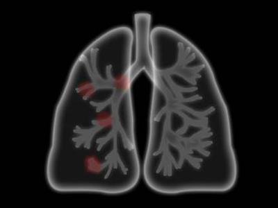 在玉林肺部CT有哪些医院可以做